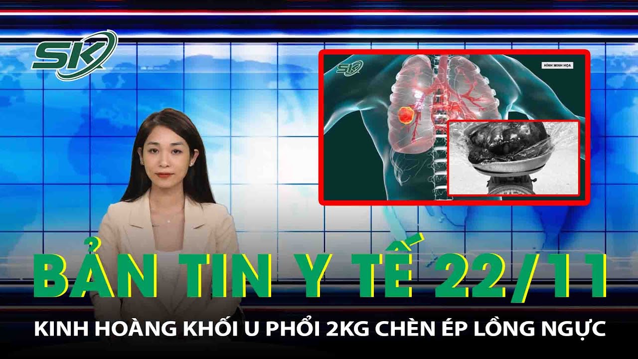 Bản Tin Y Tế 22/11: Kinh Hoàng Khối U Phổi 2kg Chèn Ép Lồng Ngực | SKĐS