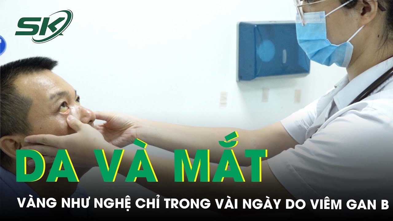 Da Và Mắt Vàng Như Nghệ Chỉ Trong Vòng Vài Ngày Vì Mắc Viêm Gan B | SKĐS