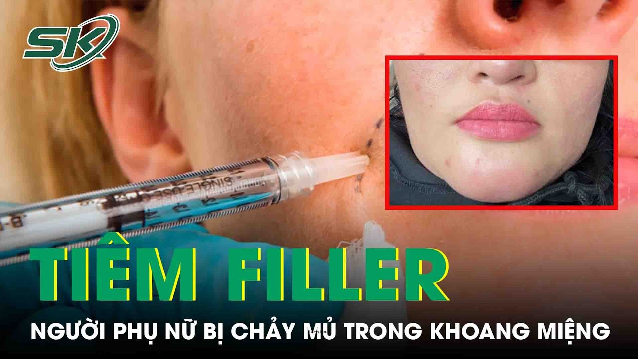 Tiêm Filler Độn Cằm, Người Phụ Nữ Bị Chảy Mủ Trong Khoang Miệng | SKĐS