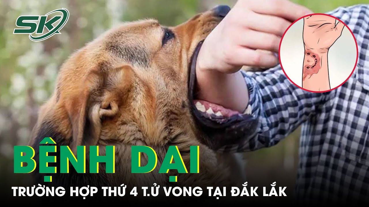 Đắk Lắk Ghi Nhận Trường Hợp Thứ 4 T.ử Vong Do Bệnh Dại | SKĐS