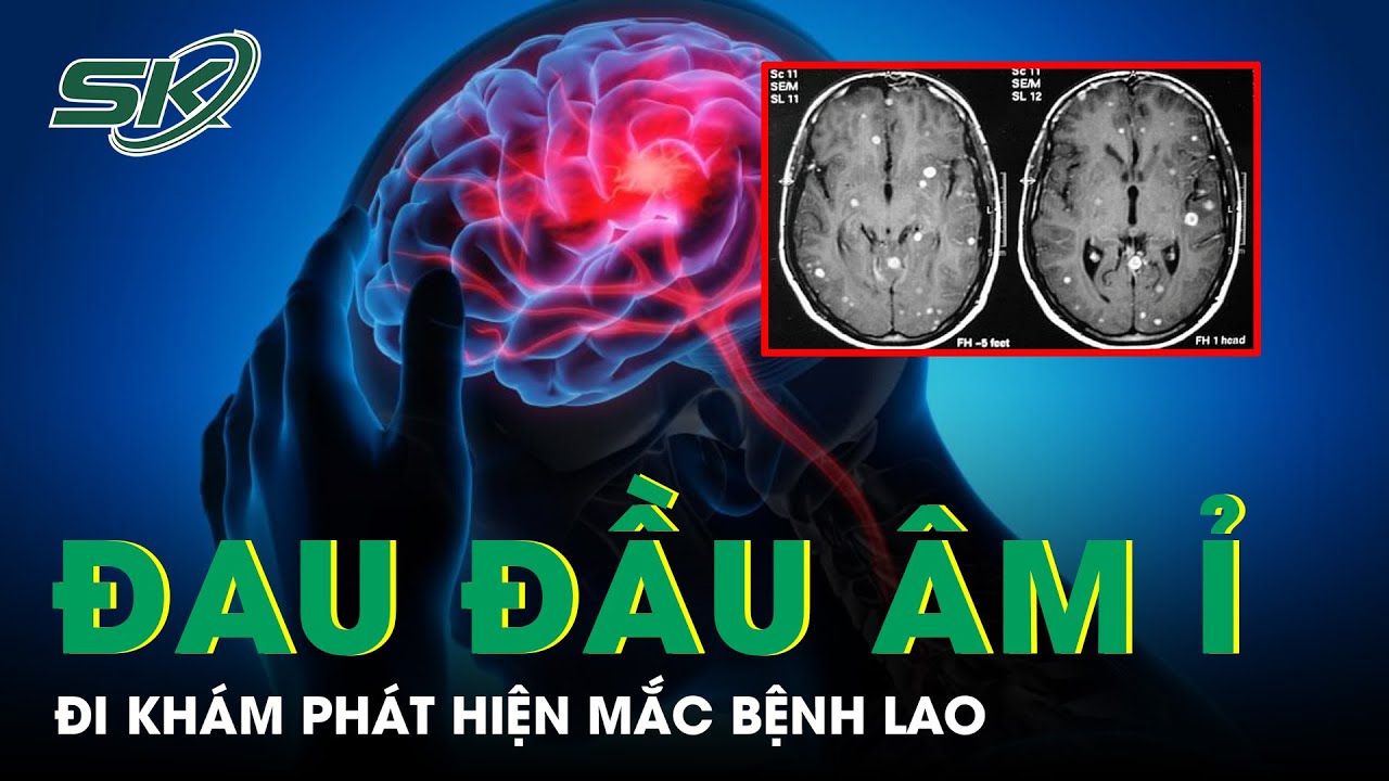 Đau Đầu Âm Ỉ Người Phụ Nữ Đi Khám Phát Hiện Mắc Bệnh Lao | SKĐS