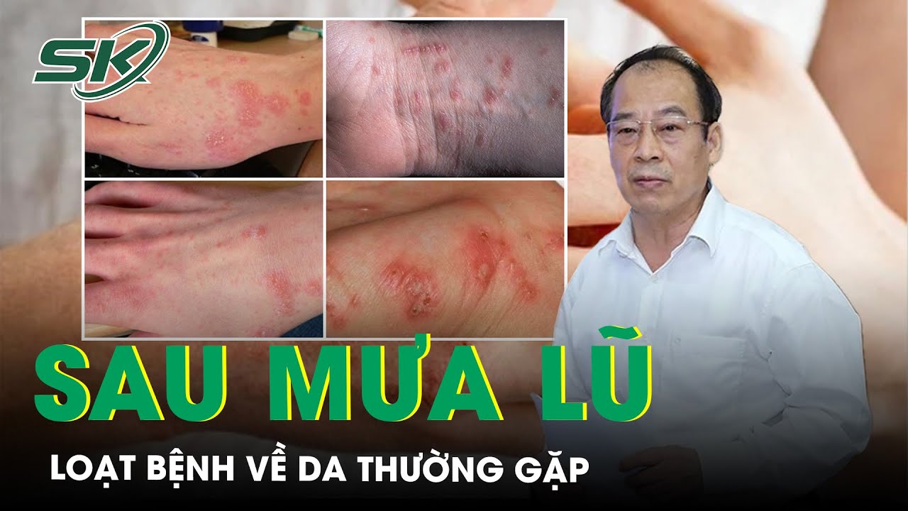 Loạt bệnh về da thường gặp sau mùa mưa lũ cần đặc biệt lưu ý | SKĐS