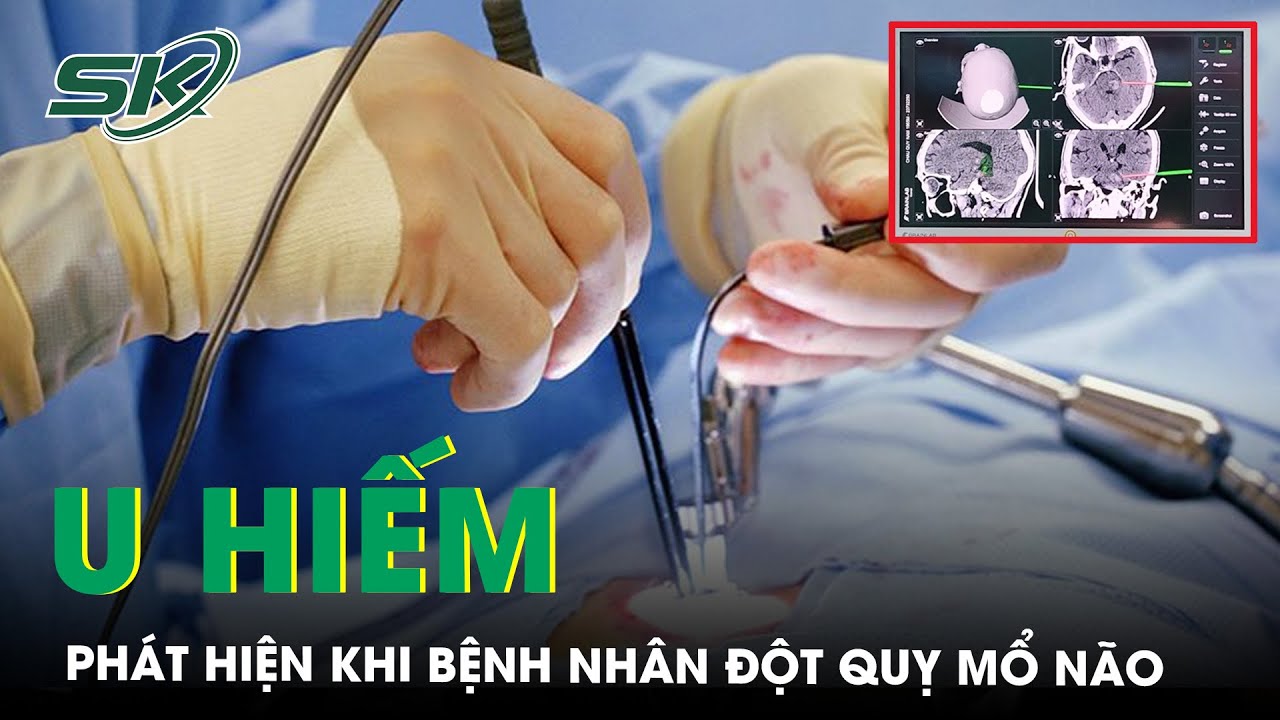 Mổ Não Bệnh Nhân Đột Quỵ, Lấy Được Khối U Hiểm | SKĐS