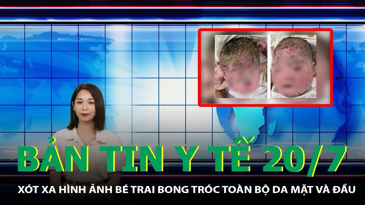 Bản Tin Y Tế 20/7: Xót Xa Hình Ảnh Bé Trai Bong Tróc Toàn Bộ Da Mặt Và Đầu | SKĐS