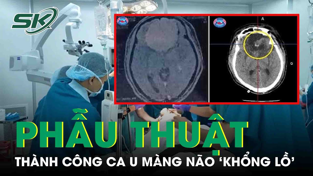 Đau Đầu, Chóng Mặt Vào Viện Phát Hiện Khối U Màng Não 'Khổng Lồ' | SKĐS