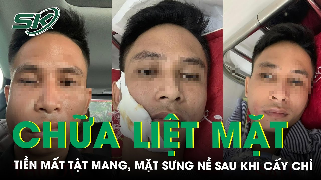 Mặt Sưng Nề Sau Khi Cấy Chỉ Chữa Liệt Mặt Ở Phòng Khám Tư | SKĐS