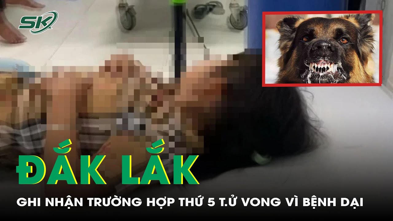 Đắk Lắk Ghi Nhận Trường Hợp Thứ 5 T.ử Vong Vì Bệnh Dại | SKĐS