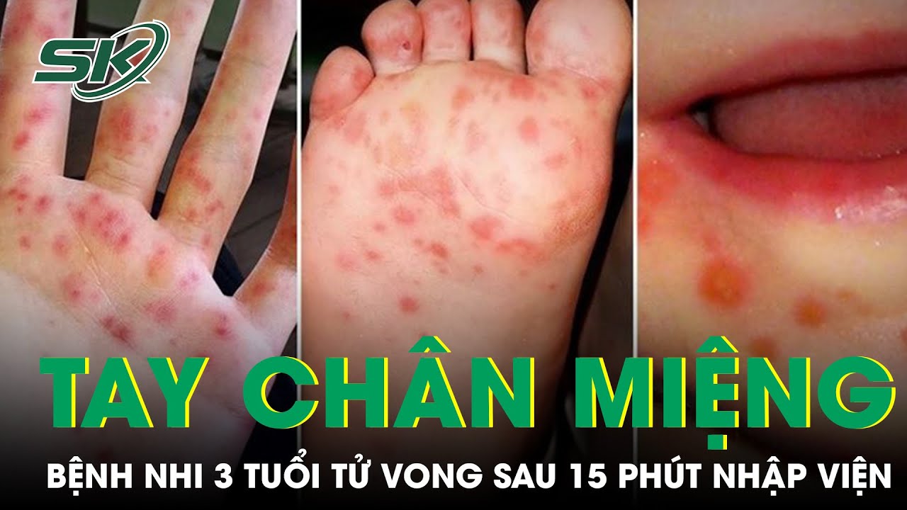 Bệnh Nhi 3 Tuổi T.ử Vong Vì Bệnh Tay Chân Miệng Sau 15 Phút Nhập Viện | SKĐS