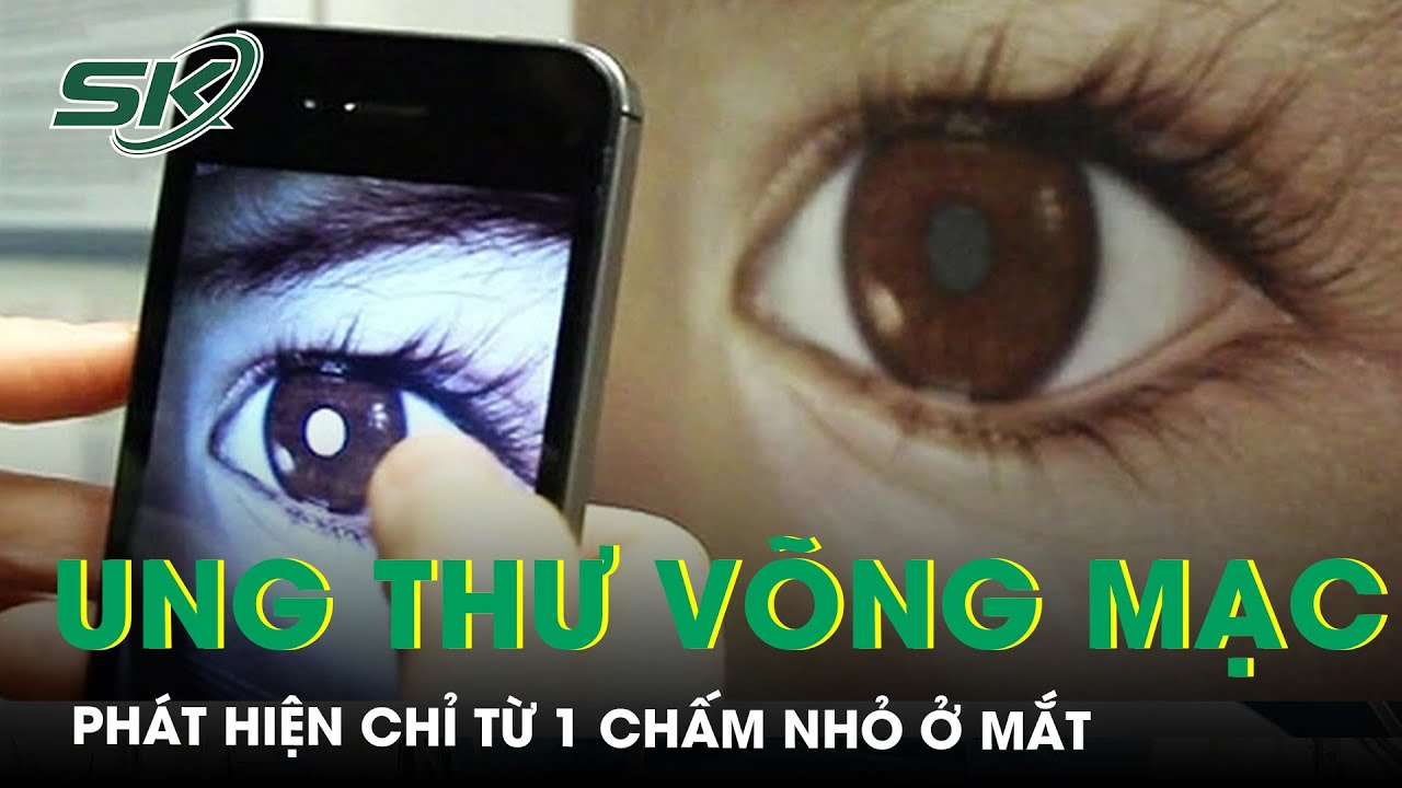 Bé 3 Tuổi Bất Ngờ Phát Hiện Ung Thư Võng Mạc Từ Chấm Nhỏ Ở Mắt | SKĐS