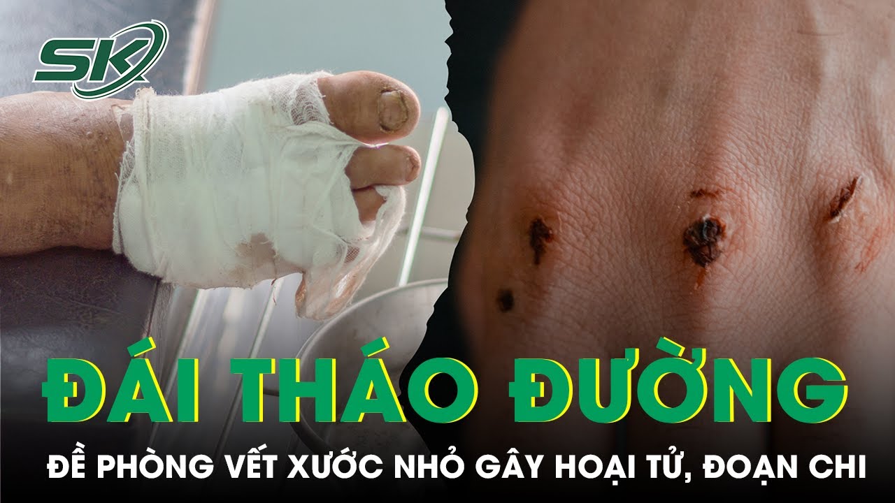 Đề phòng vết xước nhỏ gây hoại tử chân ở bệnh nhân đái tháo đường | SKĐS