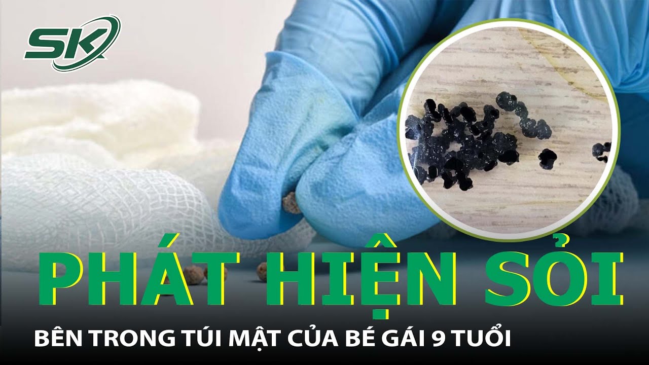 Phát Hiện Nhiều Sỏi Trong Túi Mật Của Bé Gái 9 Tuổi I SKĐS