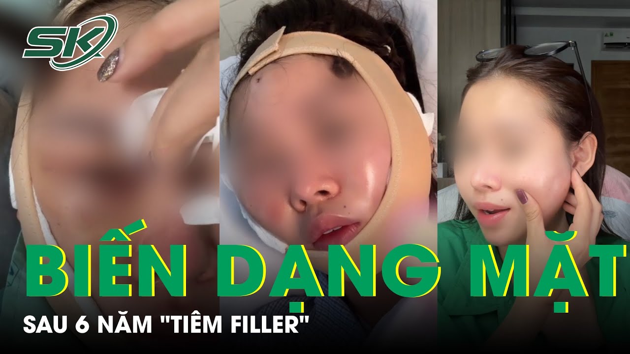 Nữ TikToker Bị Biến Dạng Mặt Sau 6 Năm "Tiêm Filler" | SKĐS