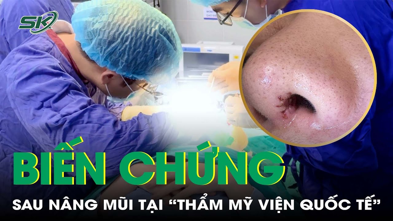 Mũi rỉ dịch, biến chứng sau khi nâng mũi tại "thẩm mỹ viện quốc tế" | SKĐS