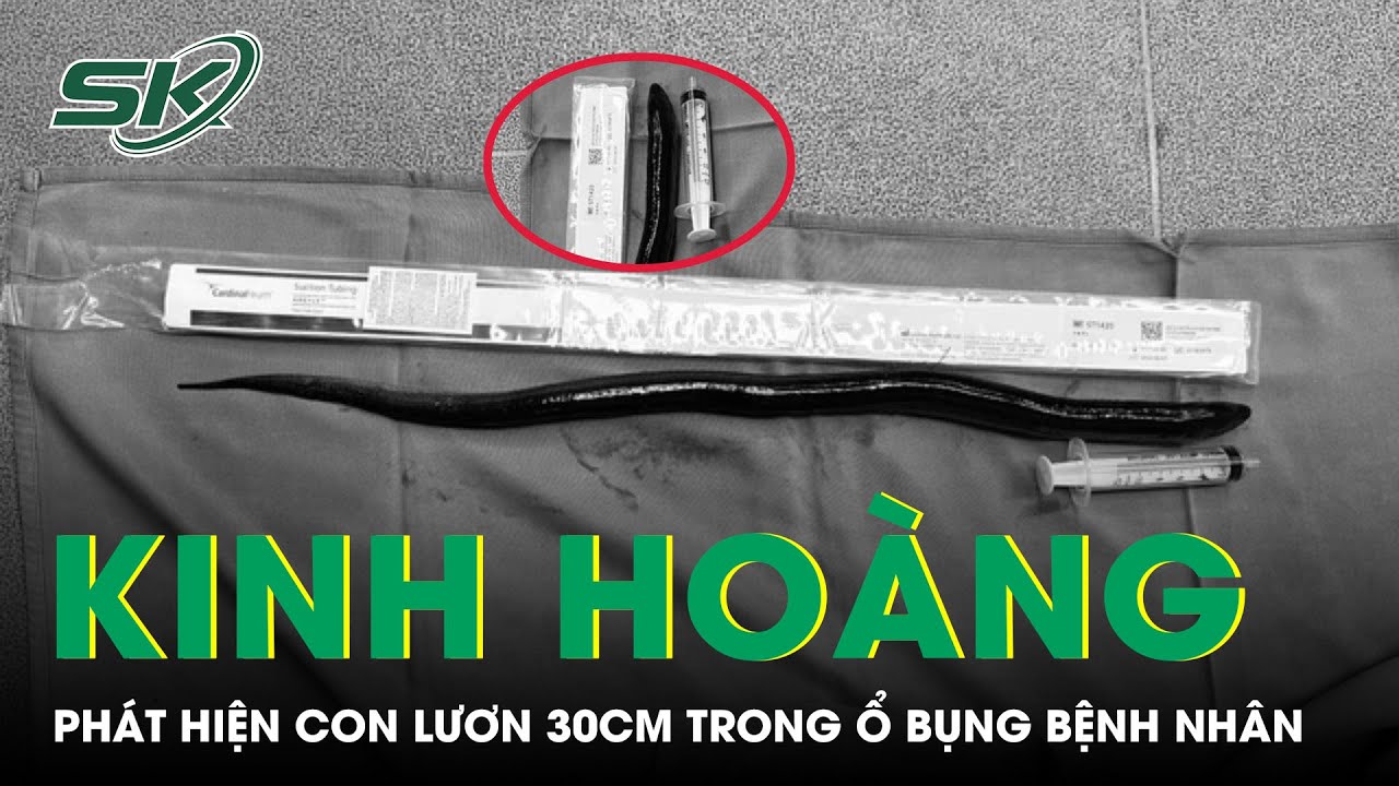 Kinh Hoàng Phát Hiện Con Lươn 30 Cm Trong Ổ Bụng Bệnh Nhân | SKĐS