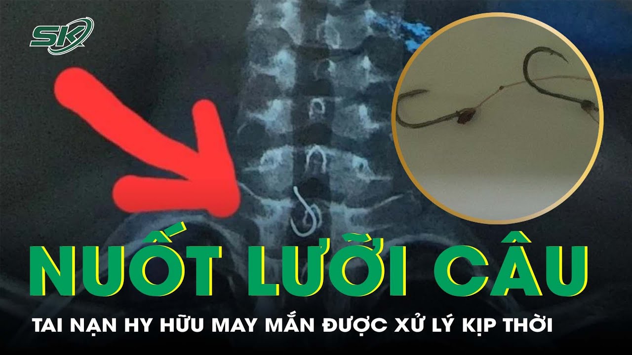 Nội Soi Gắp Lưỡi Câu Bị Mắc Kẹt Ở Thực Quản Cho Bênh Nhi 13 Tuổi I SKĐS