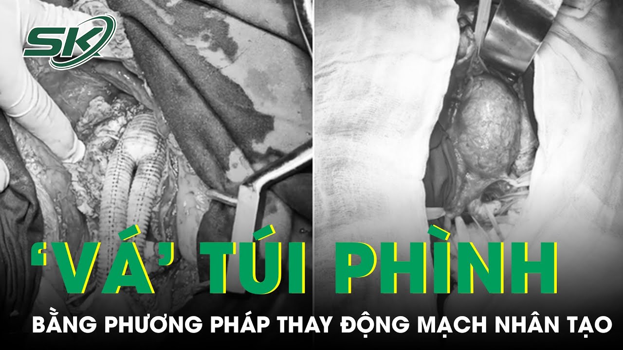 Thay Động Mạch Nhân Tạo 'Vá' Túi Phình Dễ Vỡ | SKĐS