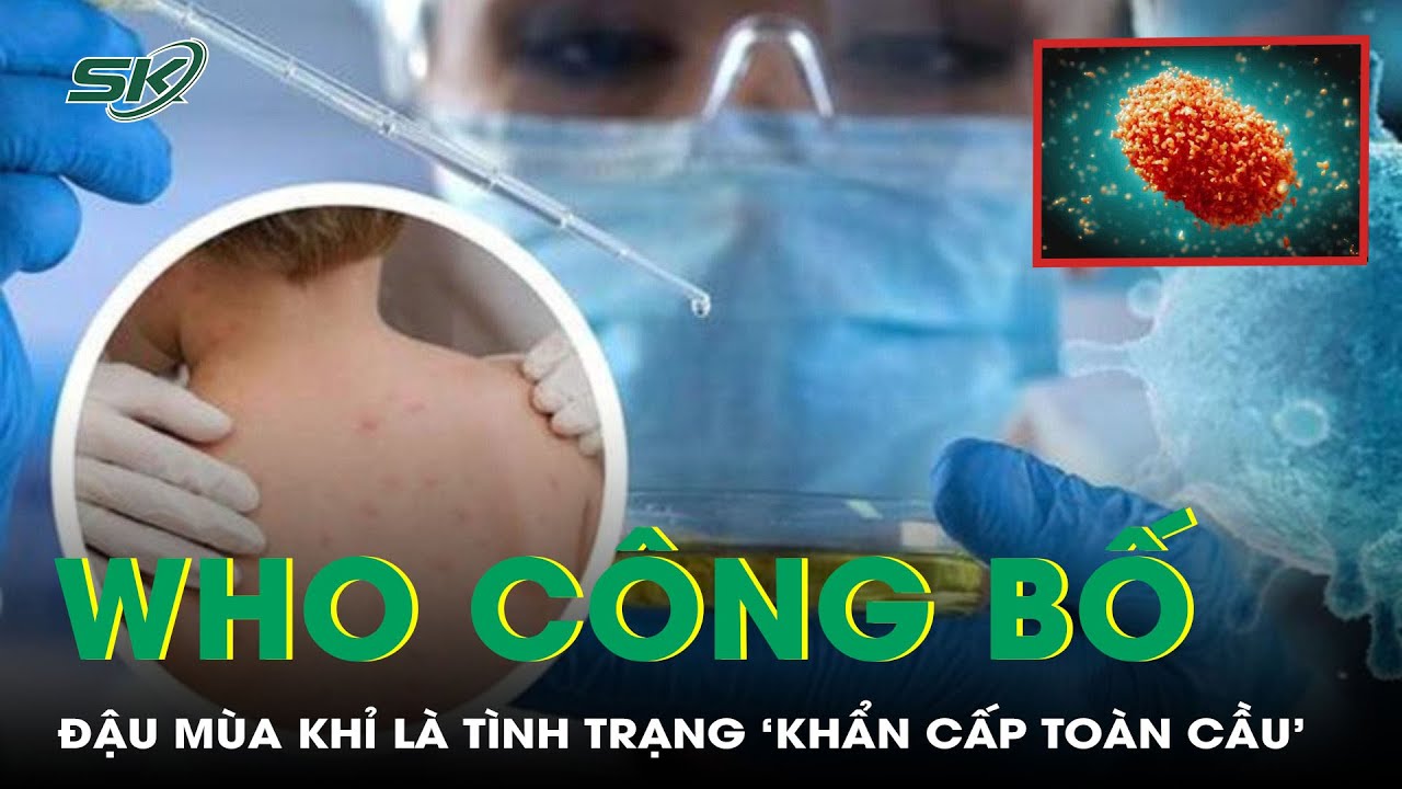 WHO công bố bệnh đậu mùa khỉ là tình trạng 'khẩn cấp toàn cầu' | SKĐS