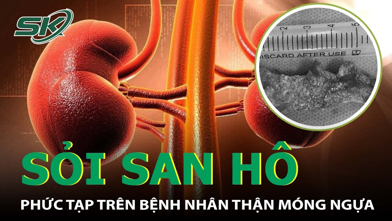 Phẫu Thuật Thành Công Sỏi San Hô Phức Tạp Trên Bệnh Nhân Thận Móng Ngựa I SKĐS