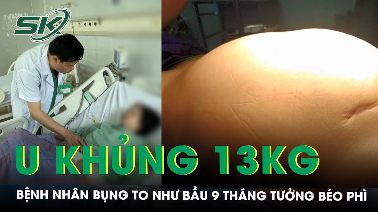 Phẫu Thuật Thành Công Khối U Buồng Trứng Ác Tính “Khổng Lồ” 13kg | SKĐS