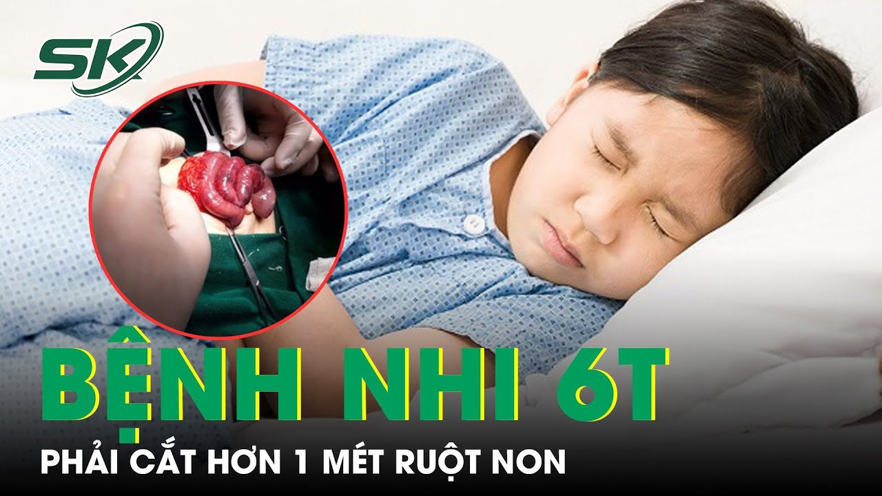 Cắt Hơn 1 Mét Ruột Non Để Cứu Sống Bệnh Nhi 6 Tuổi | SKĐS