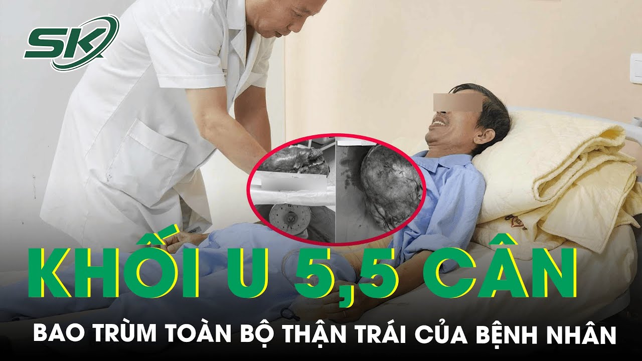 Cắt Bỏ Khối U Nặng 5,5kg Bao Trùm Toàn Bộ Thận Trái 1 Bệnh Nhân I SKĐS