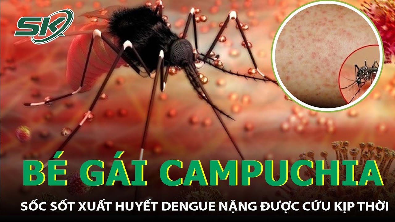 Cứu Thành Công Bé Gái Người Campuchia Bị Sốc Sốt Xuất Huyết Dengue Nặng I SKĐS