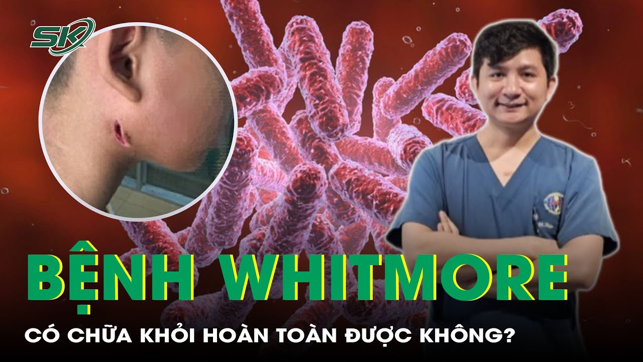 Bệnh whitmore có chữa khỏi hoàn toàn được không? | SKĐS