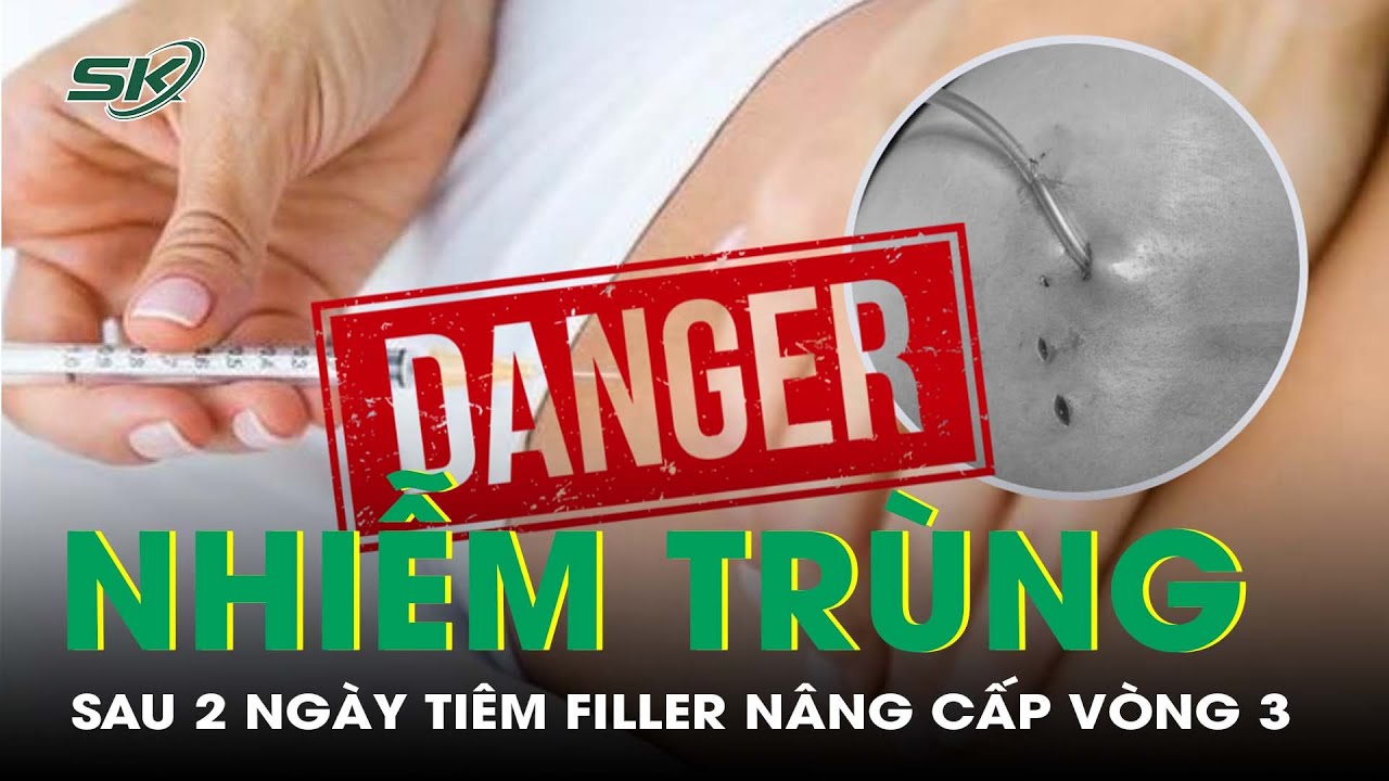 Vòng 3 Sưng Tấy, Nhiễm Trùng Sau 2 Ngày Tiêm Filler “Nâng Cấp” I SKĐS