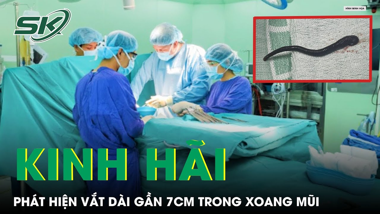 Kinh Hãi Phát Hiện Vắt Dài Gần 7Cm Sống Trong Xoang Mũi | SKĐS