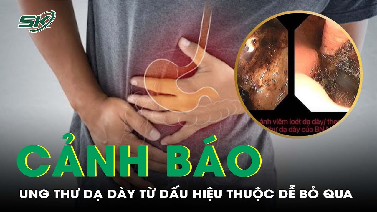 Dấu Hiệu Quen Thuộc Cảnh Báo Ung Thư Dạ Dày Không Thể Bỏ Qua | SKĐS