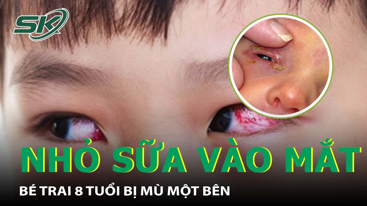 Bé Trai 8 Tuổi Bị Mù Một Bên Mắt Vì Nhỏ Sữa Mẹ Theo Quan Niệm Dân Gian I SKĐS