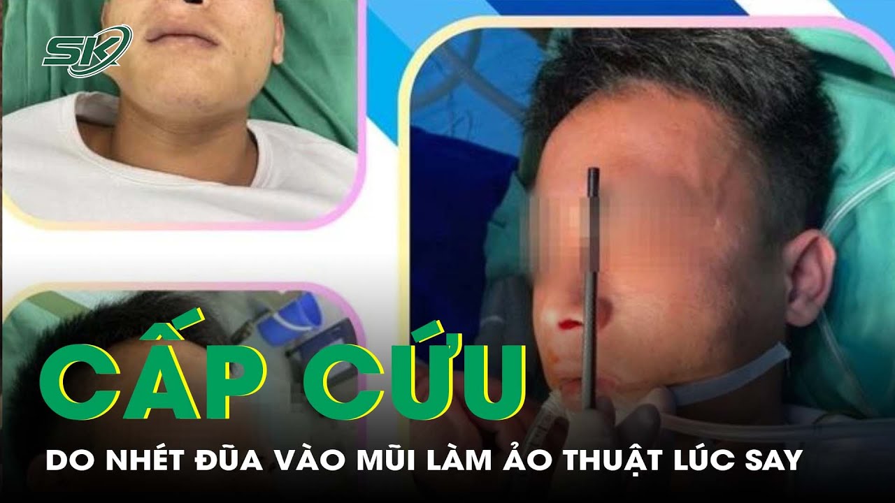 Cấp Cứu Do Nhét Đũa Vào Mũi Làm Ảo Thuật Trong Lúc Say | SKĐS