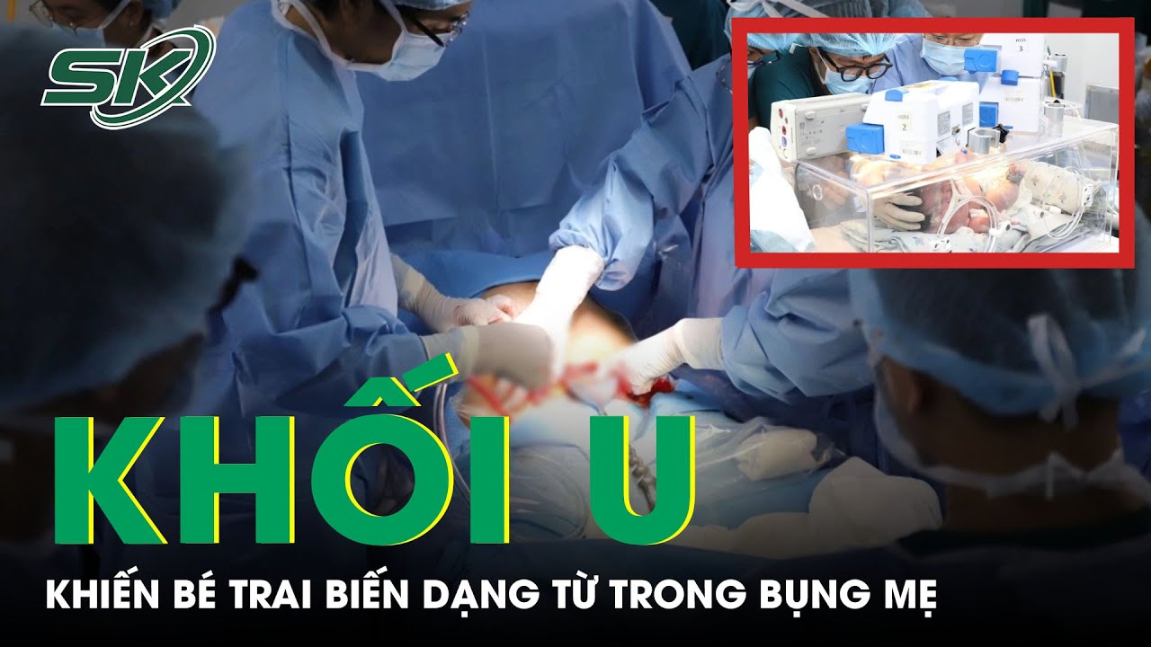 Bé Trai Bị Khối U Làm Biến Dạng Mặt, Chèn Ép Đường Thở Từ Trong Bụng Mẹ | SKĐS