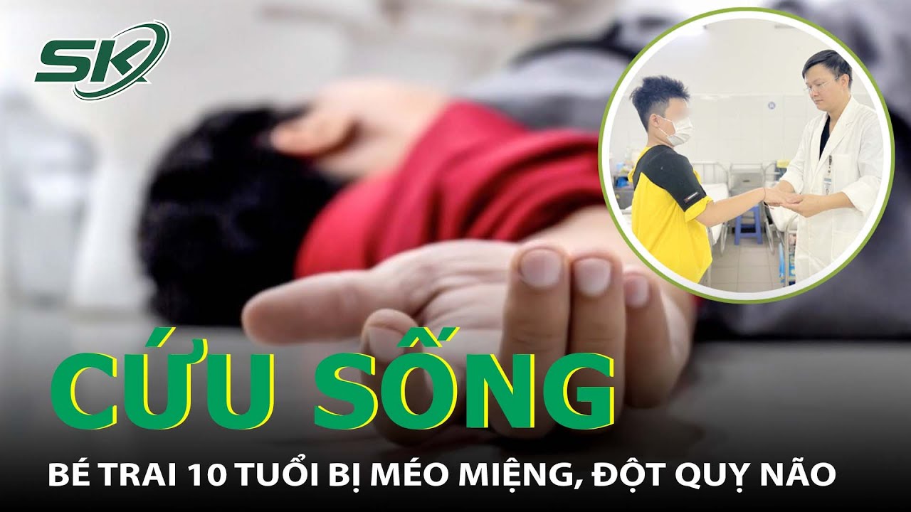 Cấp Cứu Trong Đêm Bé Trai 10 Tuổi Méo Miệng, Lơ Mơ Vì Đột Quỵ Não I SKĐS