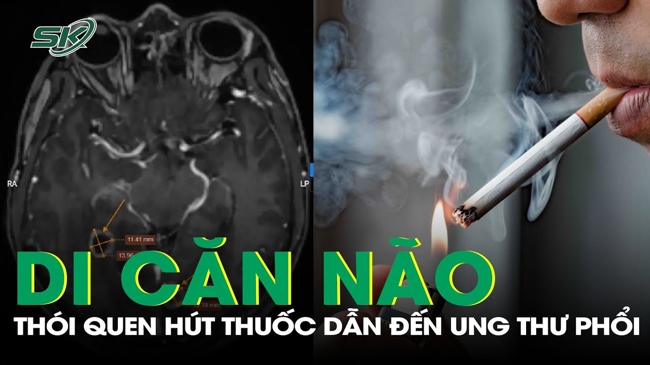 Phát Hiện Ung Thư Phổi Di Căn Não Do Thói Quen Khó Bỏ Suốt 30 Năm | SKĐS