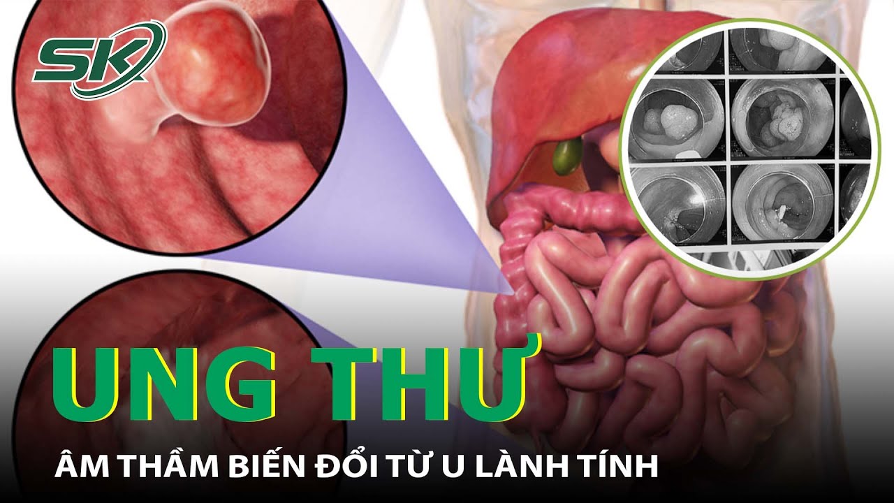 U Lành Tính Bỗng Âm Thầm Chuyển Thành U Ác Tính Ở Những Vị Trí Dễ Gặp I SKĐS