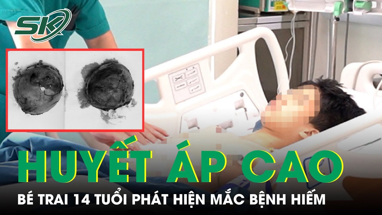 Huyết Áp Cao Liên Tục, Bé Trai 14 Tuổi Phát Hiện Mắc Bệnh Hiếm Gặp Ở Việt Nam Và Thế Giới | SKĐS