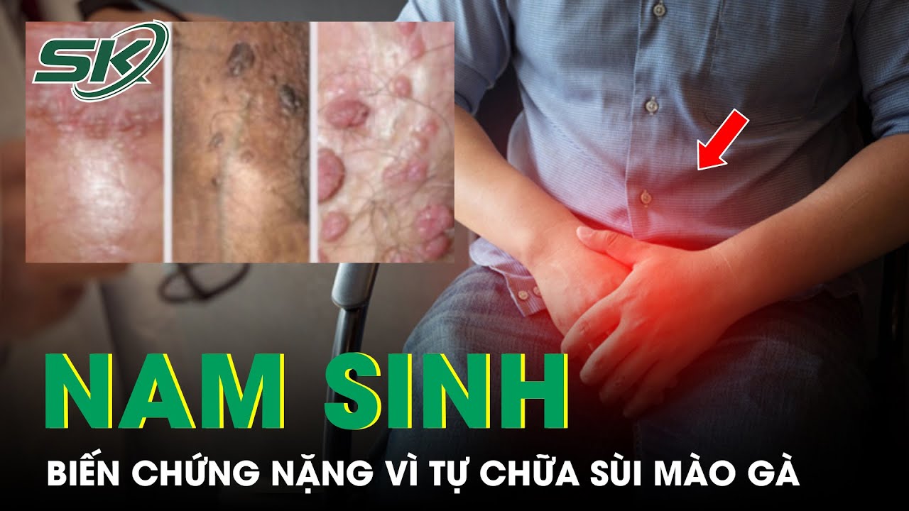 Tự chữa sùi mào gà vì đi ‘bóc bánh trả tiền’, nam sinh gặp biến chứng nặng | SKĐS