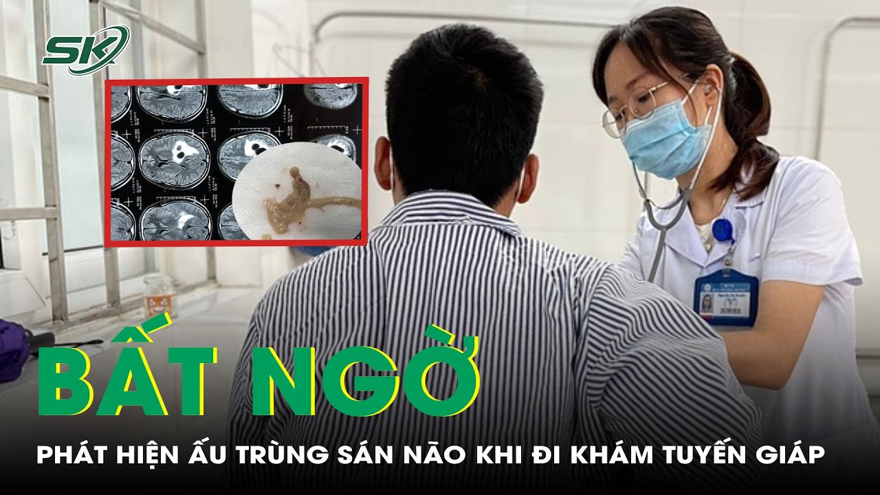 Bất ngờ phát hiện ấu trùng làm tổ trong não khi đi khám tuyến giáp | SKĐS