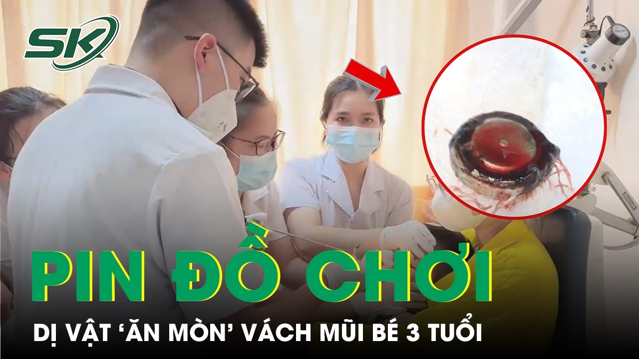 Mắc pin cúc áo trong mũi, bé trai 3 tuổi bị ‘ăn mòn’ vách mũi | SKĐS