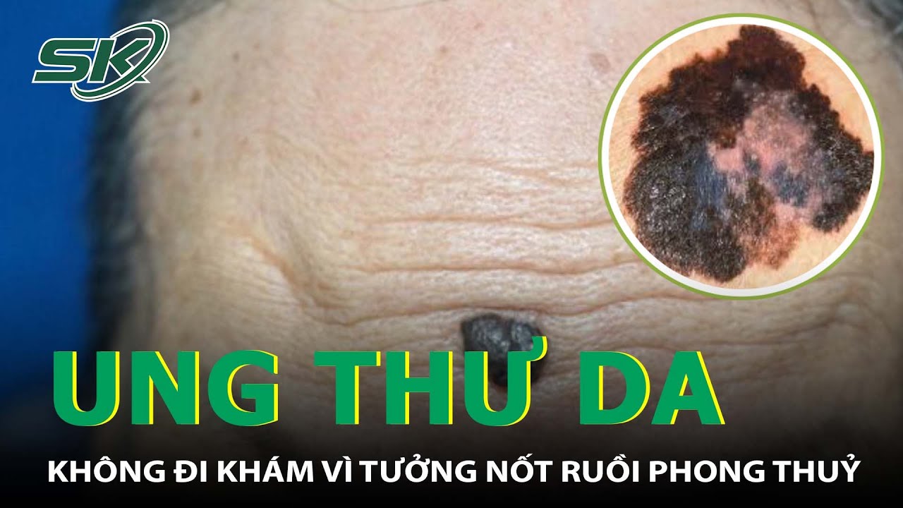 Tưởng Nốt Ruồi Phong Thuỷ, Đi Khám Mới Ngỡ Ngàng Mắc Ung Thư Da I SKĐS