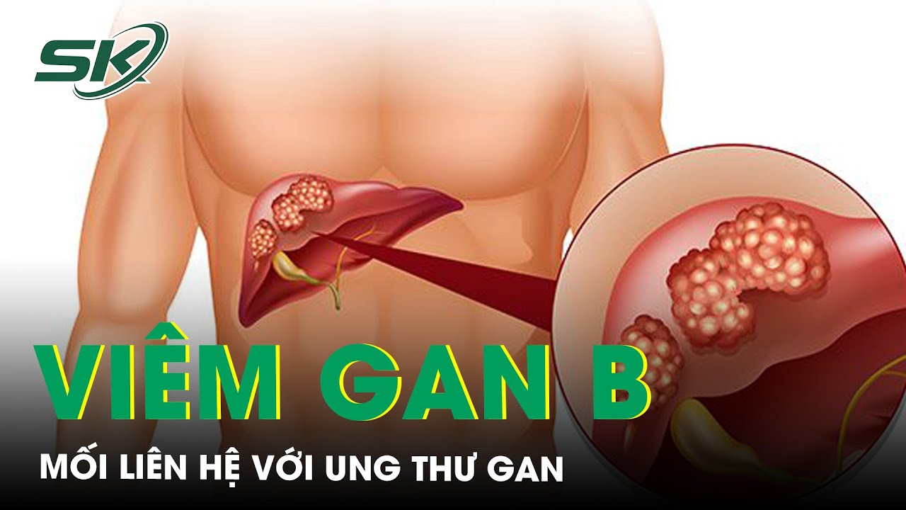 Mối liên hệ giữa viêm gan B và ung thư gan | SKĐS