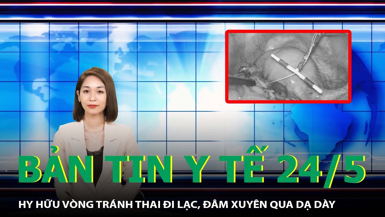 Bản Tin Y Tế 24/5: Hy Hữu Vòng Tránh Thai Đi Lạc, Đâm Xuyên Qua Dạ Dày | SKĐS