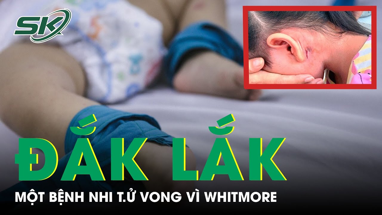 Bệnh Nhi Ở Đắk Lắk T.ử Vong Vì Whitmore | SKĐS