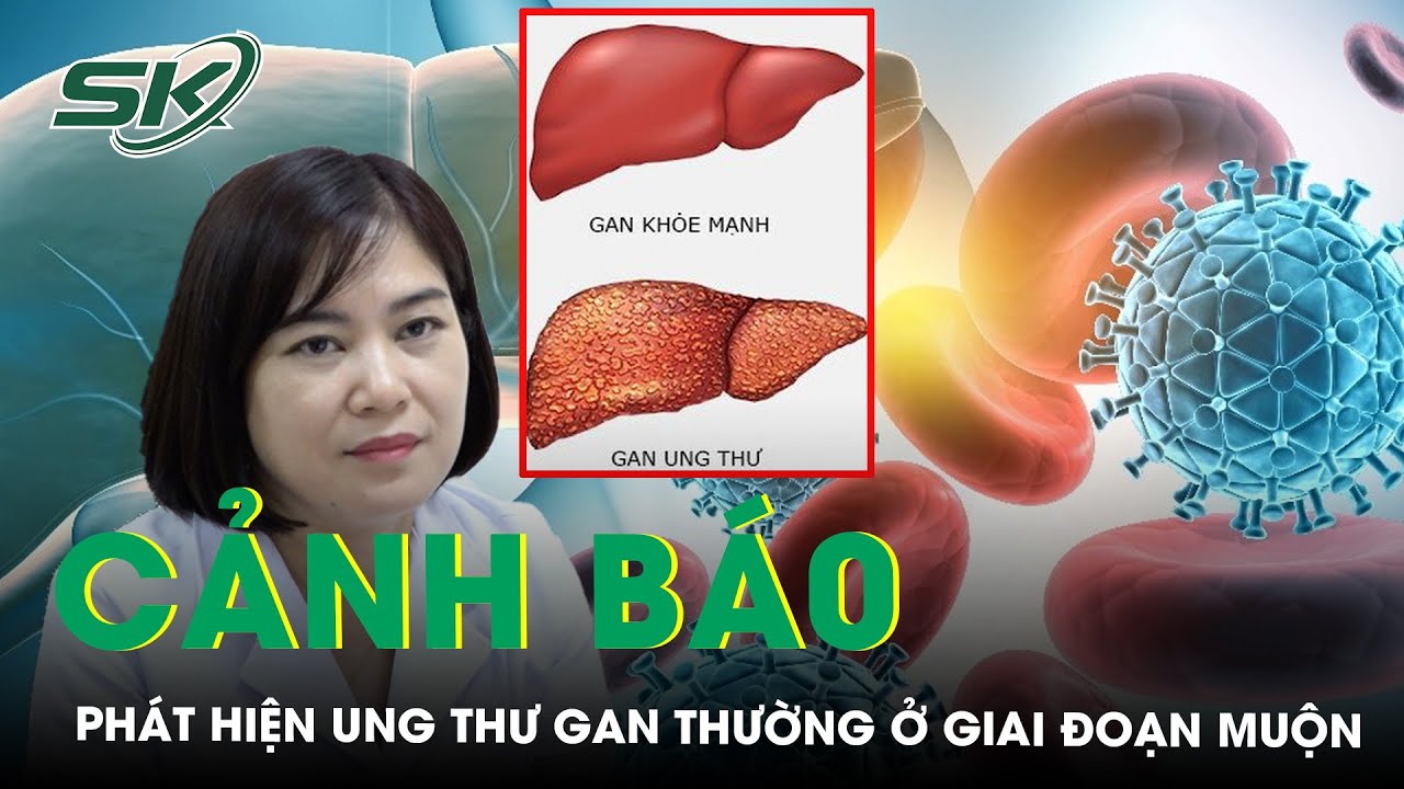 Chuyên Gia Cảnh Báo Phát Hiện Ung Thư Gan Thường Ở Giai Đoạn Muộn | SKĐS