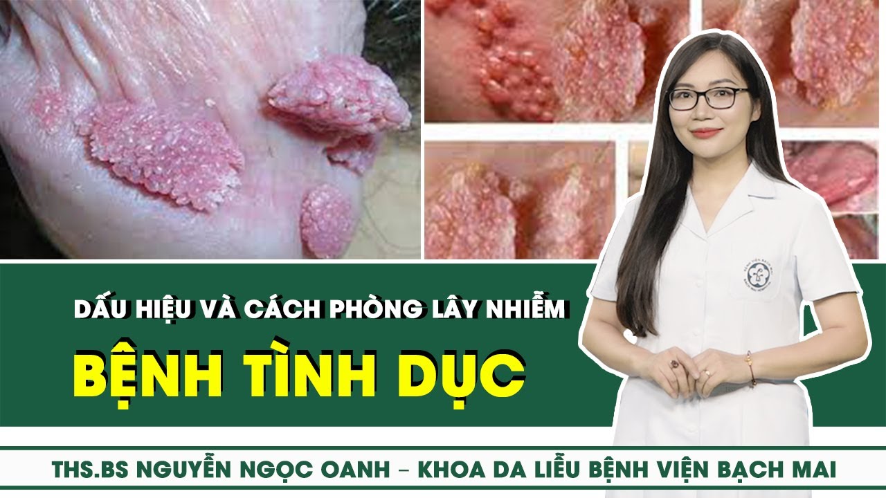 Những Bệnh Lây Qua Đường Tình Dục Phổ Biến - Dấu Hiệu Và Cách Phòng Lây Nhiễm | SKĐS