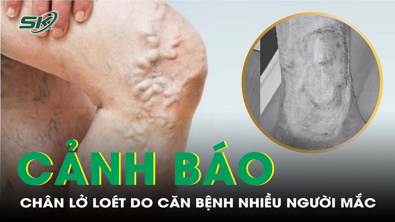 Chân Nổi Mạch Máu, Lở Loét Do Căn Bệnh Nguy Hiểm Nhiều Người Mắc I SKĐS