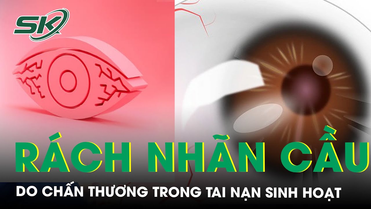 Chấn Thương Đụng Dập Và Rách Nhãn Cầu | SKĐS