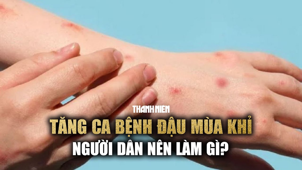 Phát hiện ca đậu mùa khỉ thứ 5, người dân nên làm gì?