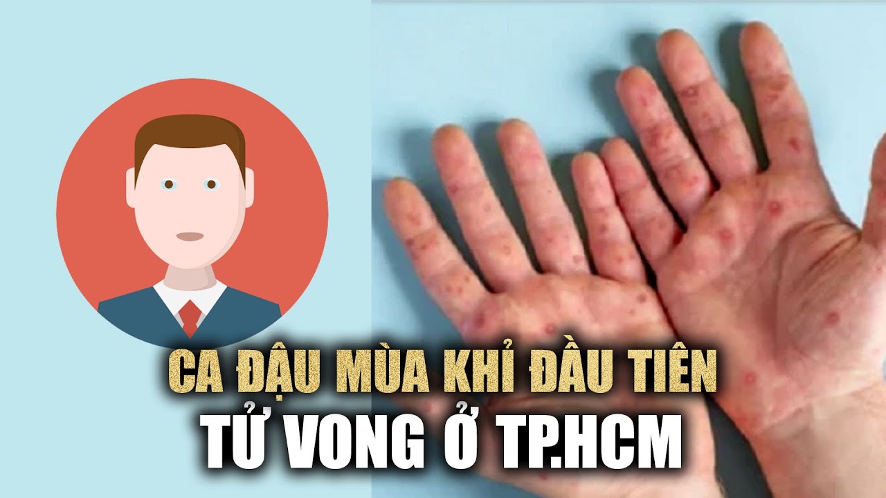 Bệnh nhân đậu mùa khỉ đầu tiên tử vong ở TP.HCM